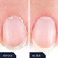 Caneta para tratamento de fungos nas unhas dos pés para unhas danificadas