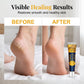 🔥PROMOÇÃO IMPERDÍVEL💞MAIS DE 50 MIL UNIDADES VENDIDAS!⏳✨Creme Hidratante Reparador Anti-Rachaduras para os Pés